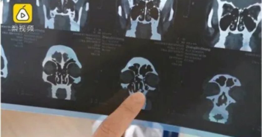 Il naso chiuso dall’uomo era causato dalla crescita di un dente nella sua narice